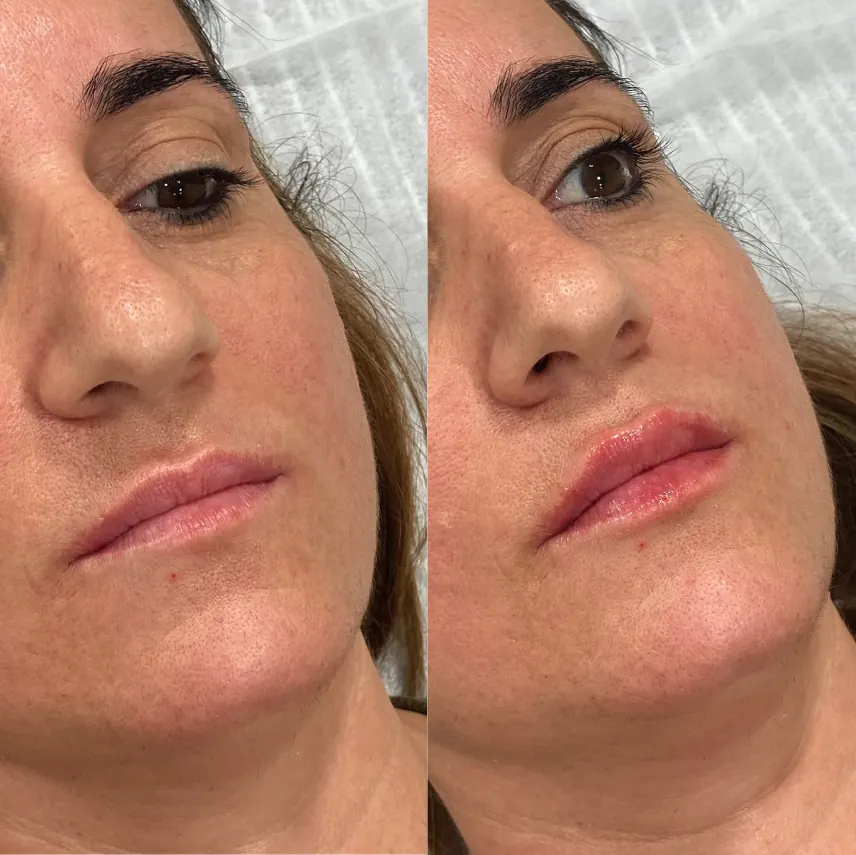 Imagen clínica de seguimiento de relleno labial, caso 1