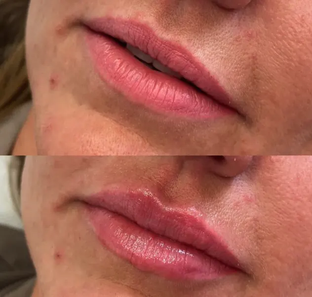 Imagen clínica de seguimiento de relleno labial, caso 2