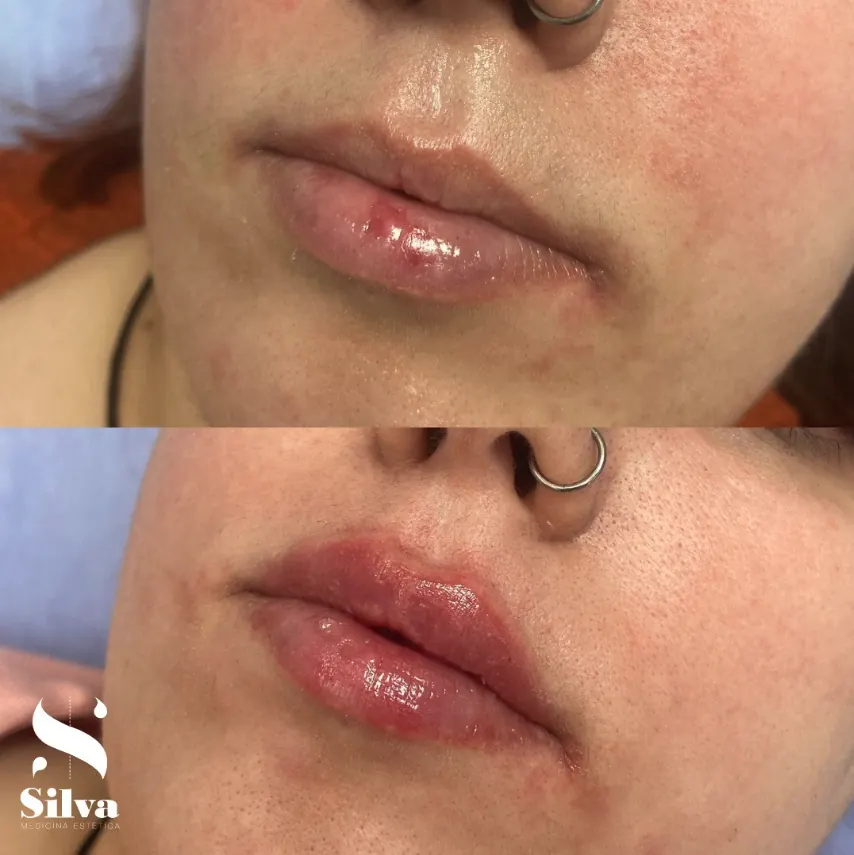 Imagen clínica de seguimiento de relleno labial, caso 3