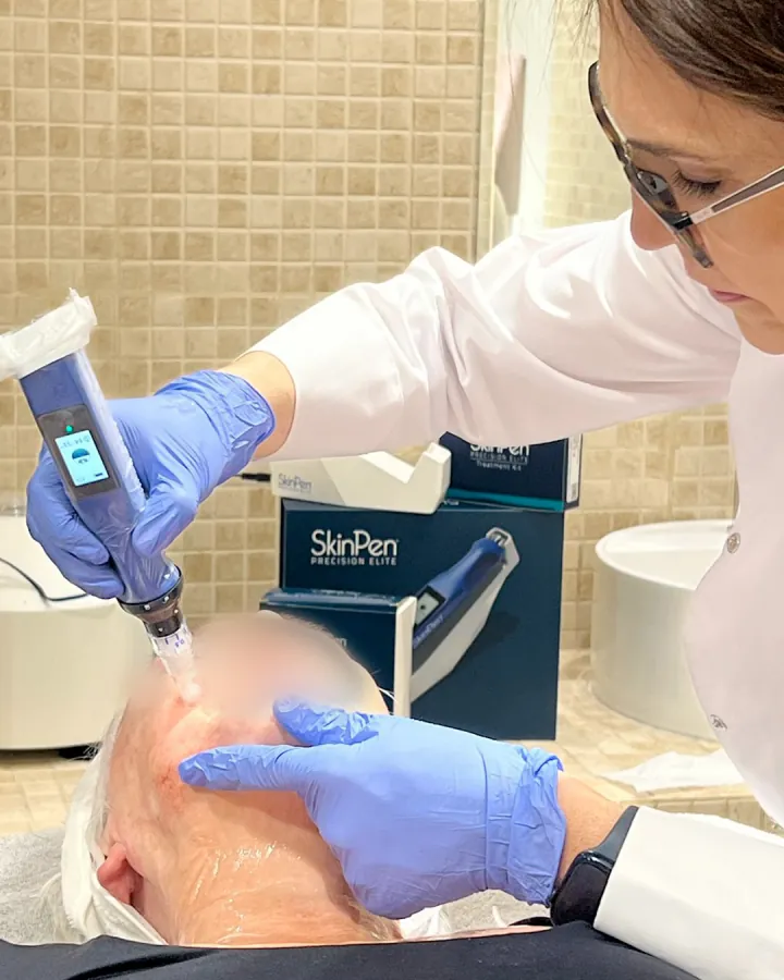 La Dra. Natalia Silva realiza un microneedling facial con SkinPen® en la consulta de Gavà